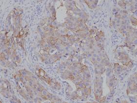 Myoepithelial or basal cells positive for CK14 focally surrounded conventional salivary duct carcinoma cells in a