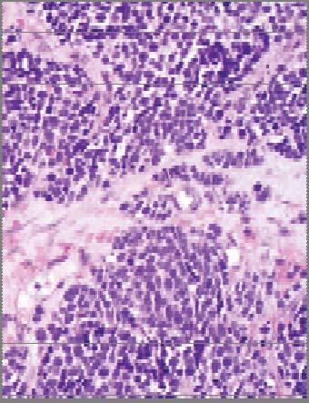 Neuroendocrine variants of oropharyngeal HPV+ carcinoma are aggressive HPV+ Small Cell