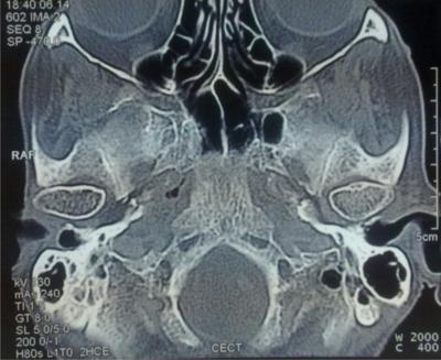 CT scan temporal bone axial view done after 2 months of CT scan head revealed