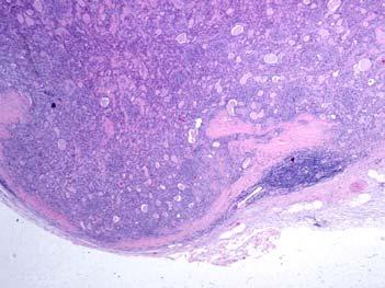 Pleomorphic Adenoma (PA) Atypical Features PAs that include atypical features but
