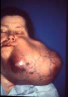 myoepithelial carcinoma, others Intracapsular or
