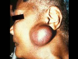 Mucoepidermoid Carcinoma (MEC) Definition Malignant epithelial salivary gland tumor composed of