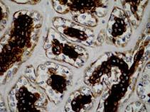 cell carcinoma Mammary analogue secretory