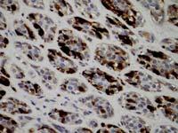 cell carcinoma Epithelial-Myoepithelial