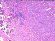 Epithelial-Myoepithelial Carcinoma (EMC) Mucoepidermoid Carcinoma Prognosis & Microscopic Grading