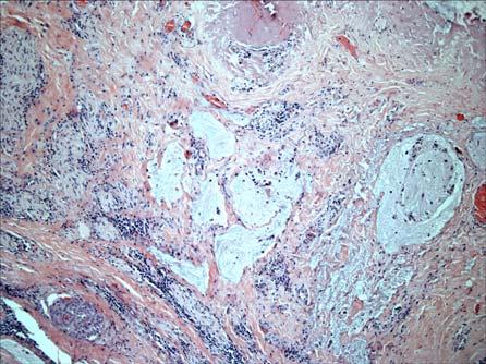 Warthin Tumor, Infarcted & Metaplastic Mucoepidermoid Carcinoma MAML2 Translocation Identified in large proportion of MEC of the salivary gland: