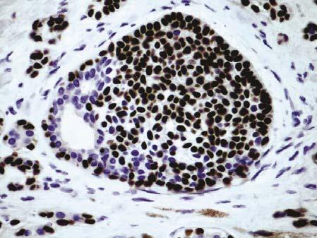 p63 Adenoid Cystic Carcinoma Immunohistochemistry Ductal (luminal) cells: