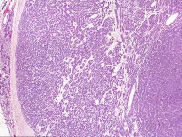 Adenoid Cystic Carcinoma Differential Diagnosis Pleomorphic