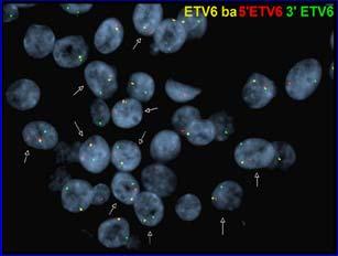 clear cell myoepithelial carcinoma PLGA; CAMSG Acinic cell Adenocarcinoma Gene Fusion PLAG1; HMGA2 CRTC1-MAML2 MYB-NFIB ETV6-NTKR3