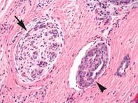 Basal Cell Adenocarcinoma PNI LVI Squamous Acinic Cell Adenocarcinoma Definition Malignant epithelial salivary gland neoplasm characterized by a variety of histologic growth patterns and the tendency