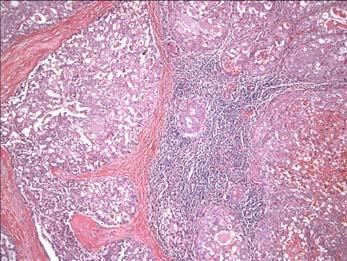 Tumor-Associated Lymphoid Proliferation (TALP) Termed coined by Auclair (Oral Surg Oral Med Oral Pathol 1994;77:19-26) Seen in wide variety of salivary gland lesions: Nonneoplastic; Neoplasms (benign