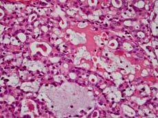 painless mass No known cause(s) MASC Histopathology Overlapping features with acinic cell carcinoma