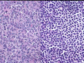 PLGA Differential Diagnosis Adenoid cystic carcinoma Pleomorphic adenoma Monomorphic adenomas Cribriform adenocarcinoma of minor salivary glands (CAMSG) Pairing p63 and p40 IHC pairing p63 and p40