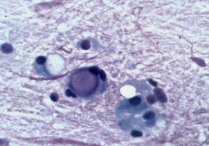 epithelium Foamy macrophages and