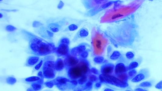 Metastatic Squamous Cell Carcinoma: Keratinization Favors This Diagnosis Summary Use a