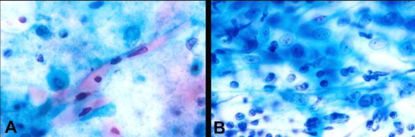 Differential Diagnosis of LESA Chronic sialadenitis Reactive intraparotid lymph node HIV-associated lymphoepithelial cyst