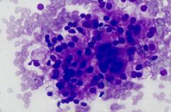 carcinoma Metastatic renal cell carcinoma
