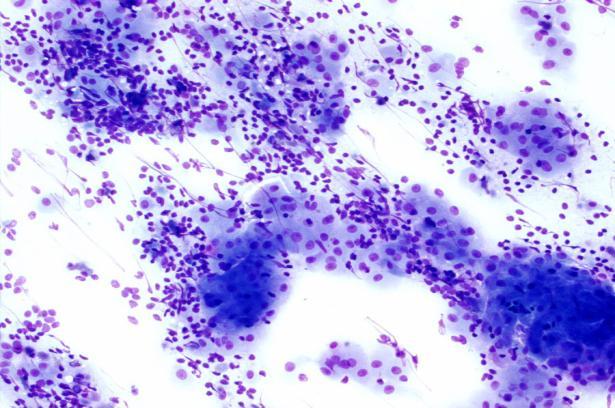 oncocytes, and background debris