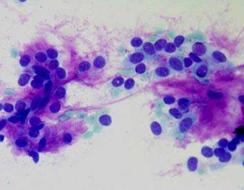Pleomorphic Adenoma/ Benign Mixed Tumor Bland