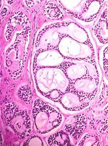 Adenoid cystic carcinoma 2 nd most common malignant parotid tumor,?