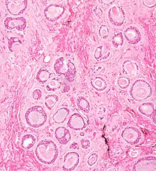 edu Cribriform patternpseudoglandular spaces filled with cylinders of PAS+