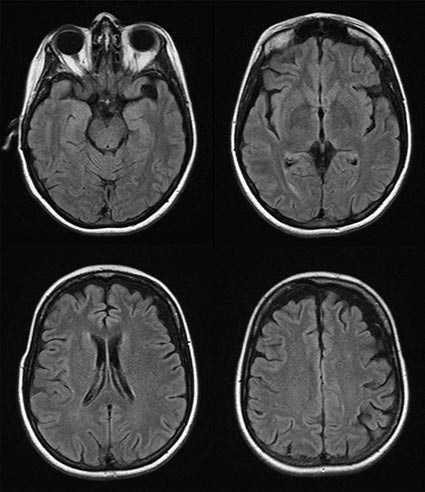 patient, however, demonstrated normal cortical excitability, without neuro physiological evidence of dy sfunction involving the co rticospinal tract. Figure 1 MRI of the patient s brain.