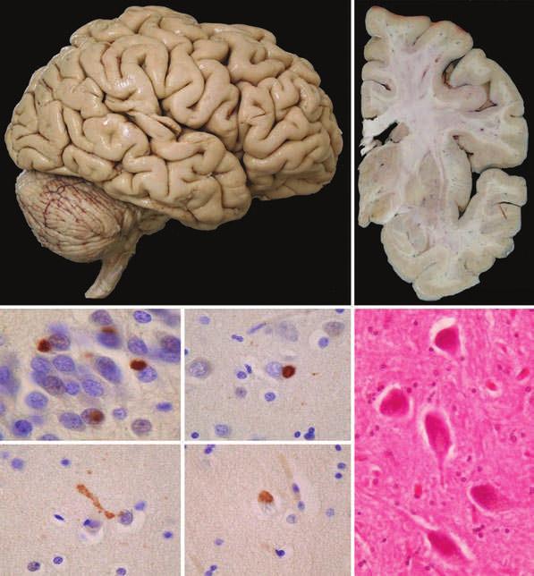 a c d g e f Figure 2 Neuropathology of the patient s brain. a Mild atrophy of the anterior frontal lobe could be seen on external examination of the right hemisphere (bar 2 cm).