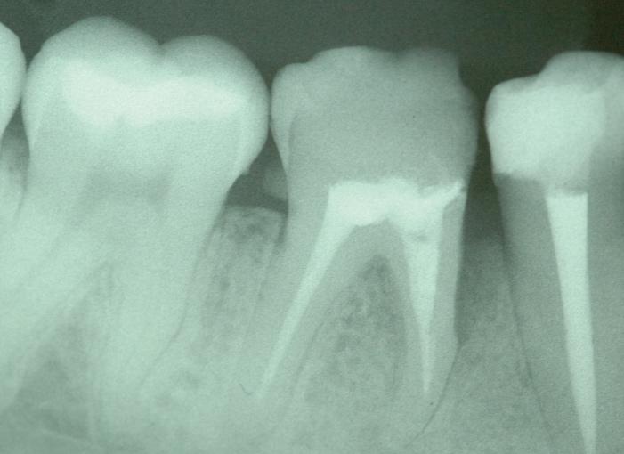 gingival recessions in buccal surface of tooth #45 and