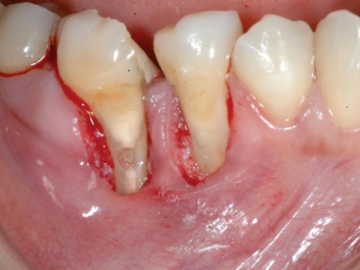 Active carious injury in mesial root of tooth #46 Figure 4