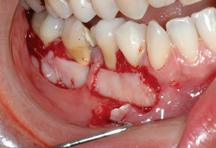 area. Four months after the operation, a metallic nucleus and metallic-ceramic prosthesis was constructed for the right mandibular first molar.