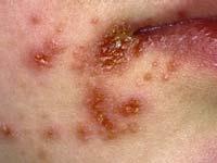 This type of staph infection, known as community-acquired or community-associated methicillin-resistant Staphylococcus aureus (CA-MRSA), can be carried by healthy adults and children who do not have