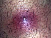 An abscess is an infection characterized by a collection of pus underneath a portion of the skin. Bacteria commonly causing abscesses are Staphylococcus aureus and Streptococcus.