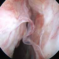 ovarian surface and fossa