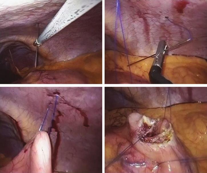 764 LUTFI ET AL. FIG. 7. Applying Prolene sutures for retraction and exposure. At laparoscopy an obvious bulge was noted in the body of stomach.