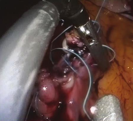 CYSTOGASTROSTOMY USING SINGLE-INCISION LAPAROSCOPY 765 FIG. 10. Reticulation proved advantageous for suturing. FIG. 12. Skin incision used to complete the operation.