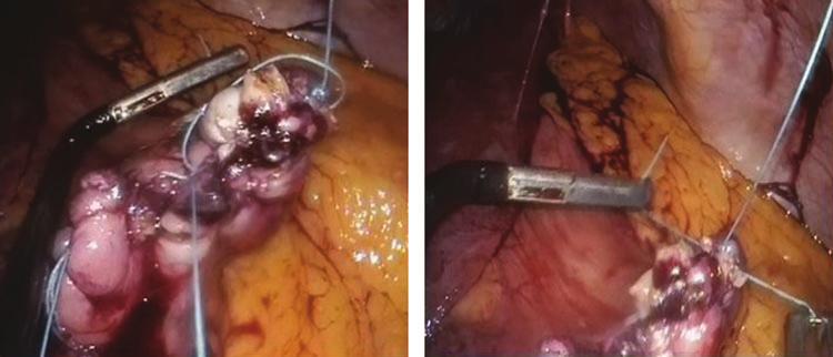 The cyst wall was then opened using a hook cautery and biopsies were obtained. About 30 cc of clear fluid was aspirated using a suction device (Fig. 8).