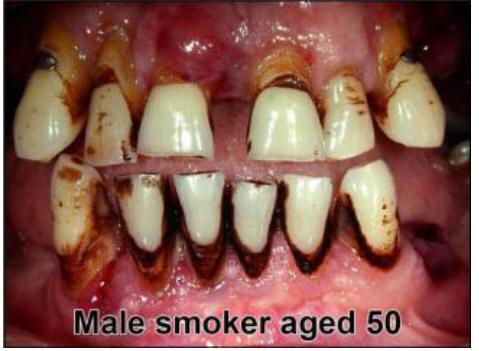 Ex smokers have whiter teeth and sweeter breath Giving up tobacco stops teeth becoming stained, and have fresher breath.