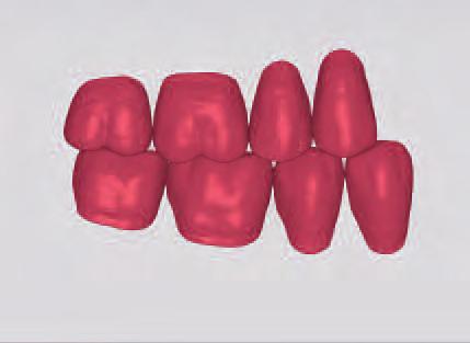 NHC SR PHONARESLingual NHC The SR PHONARESTyp NHC teeth are suitable