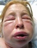 ANGIOEDEMA Definition Is the episodic, localized,