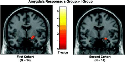 Fear Response & Serotonin Transporter Gene (SLC6A4): Short allele hetero/homozygotes show greater amygdala reactivity to