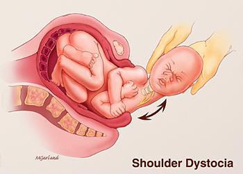Shoulder dystocia, a complication of macrosomia, is defined as
