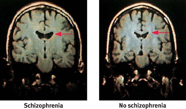 SCHIZOPHRENIA Causal Factors Biological excess dopamine receptors,