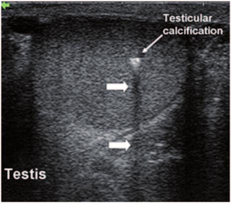3 Physical Principles of Ultrasound of the Male Genitalia 39 Fig. 14 Acoustic shadowing occurs distal to a calcification in the testis ( large arrows).