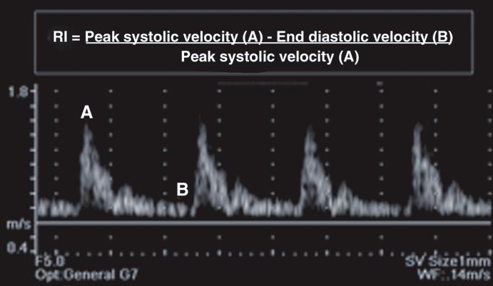 Peak systolic velocity (PSV), end diastolic velocity (EDV) and resistive index (RI) are noted Vessel/Parameter Normal value Penile artery (PSV) > 35 cm/s (after vasodilators) [5] Penile artery (EDV)