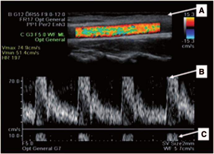 3 Physical Principles of Ultrasound of the Male Genitalia 49 Fig. 29 Spectral Doppler. a Blood flow appears unidirectional on color mapping in this color Doppler image with spectral flow analysis.
