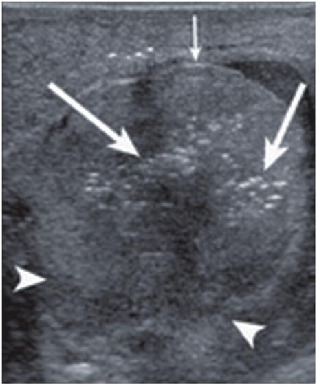 3 Physical Principles of Ultrasound of the Male Genitalia 59 Fig. 41 The risk for cavitation is higher in tissues which are in proximity to non-stabilized gas.