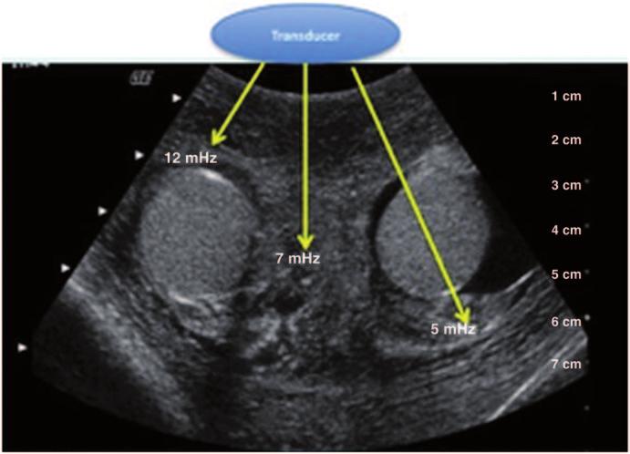 3 Physical Principles of Ultrasound of the Male Genitalia 63 Fig. 43 a The linear array transducer produces a rectangular image field.