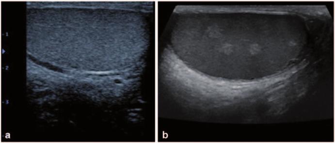 3 Physical Principles of Ultrasound of the Male Genitalia 73 Fig. 59 Sagittal view of the testis.