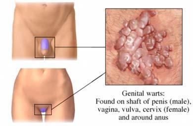 Genital Warts What causes Genital Warts?