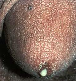 Gonorrhea Characterized by drip